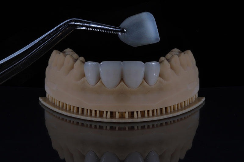 dental veneers being placed onto the jaw